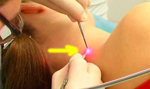 воздействие обычного лазера на кожу