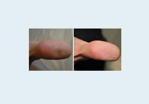 Удаление лазером шипицы на пальце - до и после