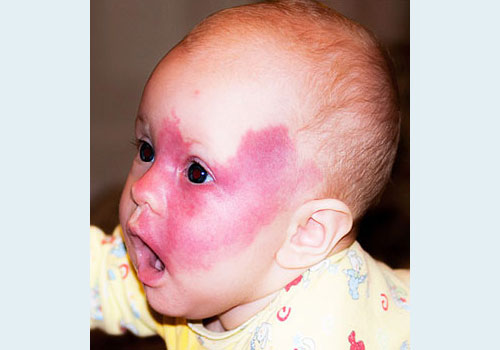 огненный невус на лице у ребенка